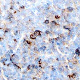 Mcl-1 antibody in Human Lymphoma by Immunohistochemistry (IHC-P).