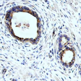 Mrc2 antibody in Human Prostate Cancer Tissue by Immunohistochemistry (IHC-P).