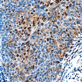 NAC1 antibody in Human Cervical Cancer Tissue by Immunohistochemistry (IHC-P).