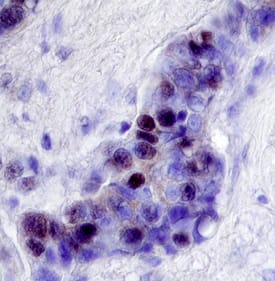 NCOR2 antibody in Human Breast Cancer Tissue by Immunohistochemistry (IHC-P).