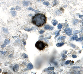 NG2/MCSP antibody in Human Skin Cancer Tissue by Immunohistochemistry (IHC-P).