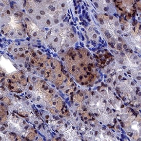 NLRP1/NALP1 antibody in Human Stomach Cancer Tissue by Immunohistochemistry (IHC-P).