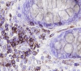 Neuromedin B R/NMBR antibody in Human Colon Cancer Tissue by Immunohistochemistry (IHC-P).