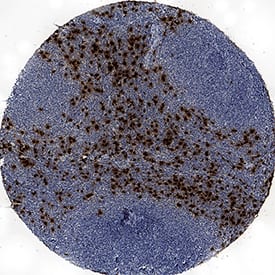 Neutrophil Elastase/ELA2 antibody in Human Lymphoma by Immunohistochemistry (IHC-P).