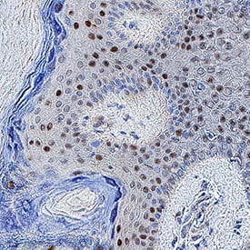 ORF73 HHV8 antibody in Kaposi's Sarcoma Skin Tissue by Immunohistochemistry (IHC-P).