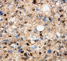 Olig1 antibody in Human Glioma by Immunohistochemistry (IHC-P).