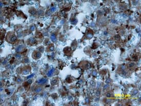 Osteocalcin antibody in Human Osteosarcoma by Immunohistochemistry (IHC-P).