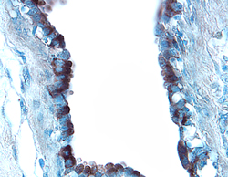 Osteopontin/OPN antibody in Human Breast Cancer Tissue by Immunohistochemistry (IHC-P).