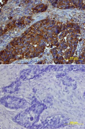 Osteopontin/OPN antibody in Human Breast Cancer Tissue by Immunohistochemistry (IHC-P).
