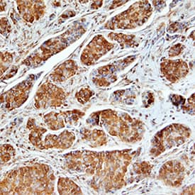 Osteopontin/OPN antibody in Human Breast Cancer Tissue by Immunohistochemistry (IHC-P).