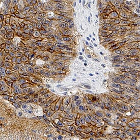PAR1 antibody in Human Colon Cancer Tissue by Immunohistochemistry (IHC-P).