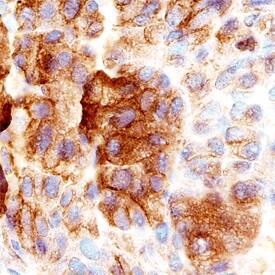 PAUF/ZG16B antibody in Human Pancreas Cancer Tissue by Immunohistochemistry (IHC-P).