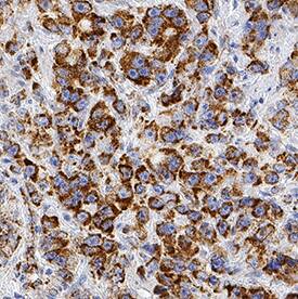 PBR antibody in Human Prostate Cancer Tissue by Immunohistochemistry (IHC-P).