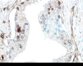 PD-ECGF/Thymidine Phosphorylase antibody in Human Prostate Cancer Tissue by Immunohistochemistry (IHC-P).