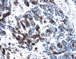 PDGF-C antibody in Human Pancreatic Cancer Tissue by Immunohistochemistry (IHC-P).