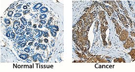 PDGF-AA antibody in Human Breast and Breast Cancer Tissue by Immunohistochemistry (IHC-P).