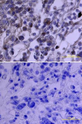 PDGF Ra antibody in Human Breast Cancer Tissue by Immunohistochemistry (IHC-P).