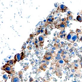 PDGF Ra antibody in Human Osteosarcoma by Immunohistochemistry (IHC-P).