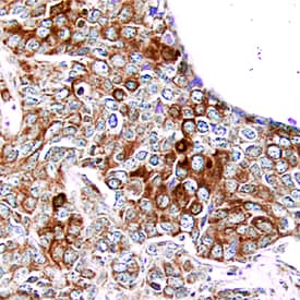 PDGF Ra antibody in Human Breast Cancer Tissue by Immunohistochemistry (IHC-P).