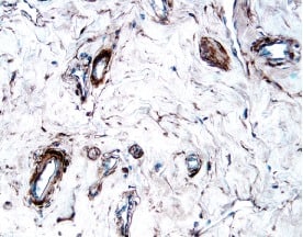 PDGF R beta antibody in Human Breast Cancer Tissue by Immunohistochemistry (IHC-P).