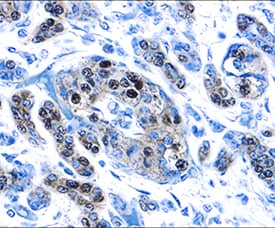 PDX-1/IPF1 antibody in Human Pancreatic Cancer Tissue by Immunohistochemistry (IHC-P).