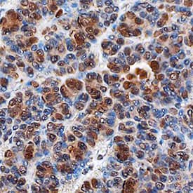 PITX2 antibody in Human Thyroid Cancer Tissue by Immunohistochemistry (IHC-P).