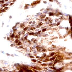 PKCe antibody in Human Lung Cancer Tissue by Immunohistochemistry (IHC-P).