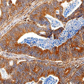 PLA2G4A antibody in Human Colon Cancer Tissue by Immunohistochemistry (IHC-P).