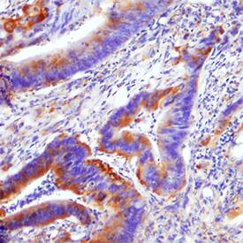 PLD2 antibody in Human Colon Cancer Tissue by Immunohistochemistry (IHC-P).