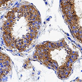 PMFBP1 antibody in Human Cervical Cancer Tissue by Immunohistochemistry (IHC-P).