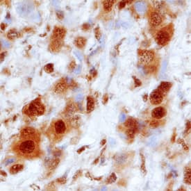 PSMA1 antibody in Human Breast Cancer Tissue by Immunohistochemistry (IHC-P).