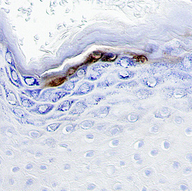 Patched 2 antibody in Human Basal Cell Carcinoma by Immunohistochemistry (IHC-P).