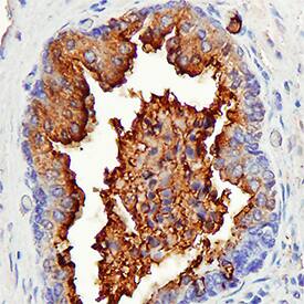 Patched 2/PTCH2 antibody in Human Cervical Cancer Tissue by Immunohistochemistry (IHC-P).