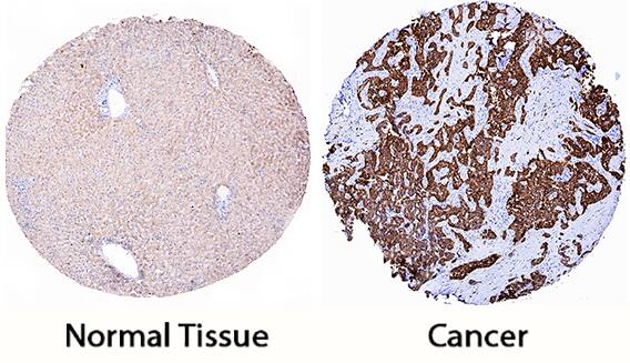 Peroxiredoxin 4 antibody in Human Liver Cancer Tissue by Immunohistochemistry (IHC-P).
