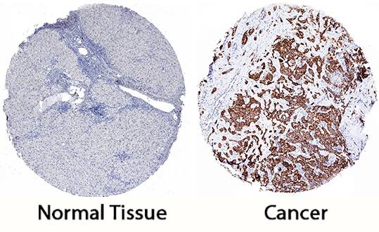 Peroxiredoxin 4 antibody in Human Liver Cancer Tissue by Immunohistochemistry (IHC-P).