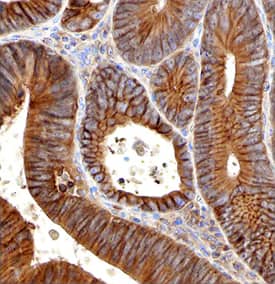 Plexin B2 antibody in Human Colon Cancer Tissue by Immunohistochemistry (IHC-P).