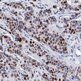Progesterone R/NR3C3 antibody in Human Prostate Cancer Tissue by Immunohistochemistry (IHC-P).