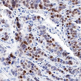 Progesterone R B/NR3C3 antibody in Human Prostate Cancer Tissue by Immunohistochemistry (IHC-P).
