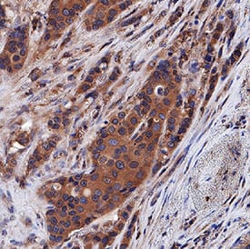 Progranulin/PGRN antibody in Human Breast Cancer Tissue by Immunohistochemistry (IHC-P).