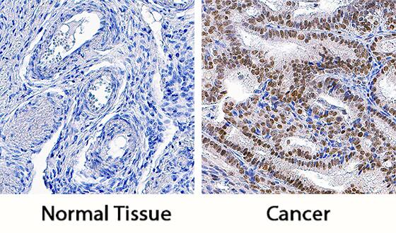 Pygopus-2 antibody in Human Ovary and Ovarian Cancer Tissue by Immunohistochemistry (IHC-P).