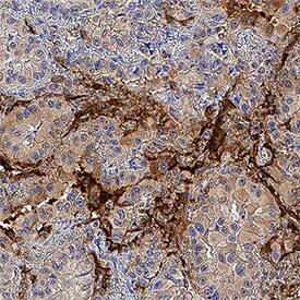 RAGE antibody in Human Liver Cancer Tissue by Immunohistochemistry (IHC-P).