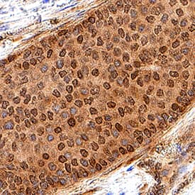 Rad51 antibody in Human Breast Cancer Tissue by Immunohistochemistry (IHC-P).