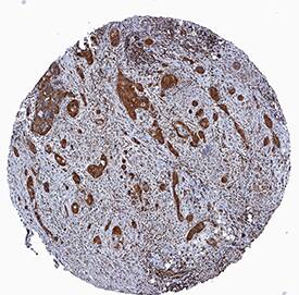 RelA/NF?B p65 antibody in Human Squamous Cell Carcinoma by Immunohistochemistry (IHC-P).