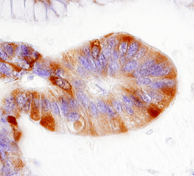 Ribosomal Protein S6 antibody in Human Colon Cancer Tissue by Immunohistochemistry (IHC-P).