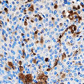 S100A4 in Human Cervical Cancer Tissue. S100A4 antibody in Human Cervical Cancer Tissue by Immunohistochemistry (IHC-P).