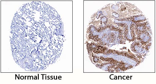 S100A8/S100A9 Heterodimer antibody in Human Lung Cancer Tissue by Immunohistochemistry (IHC-P).
