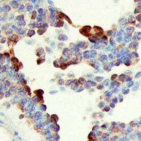 SHB antibody in Human Ovarian Cancer Tissue by Immunohistochemistry (IHC-P).