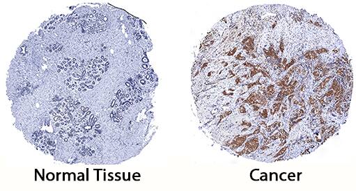 SHIP2 antibody in Human Breast Cancer Tissue by Immunohistochemistry (IHC-P).