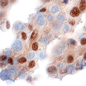 SOX10 antibody in Human Melanoma Tissue by Immunohistochemistry (IHC-P).