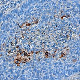 Serpin B3/SCCA1 antibody in Human Squamous Cell Carcinoma by Immunohistochemistry (IHC-P).